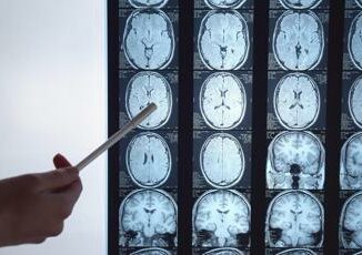 Calcio e ripetute commozioni cerebrali neurologa Rischi a lungo termine