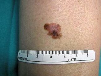 Tumori contro melanoma il virus dellherpes modificato funziona lo studio