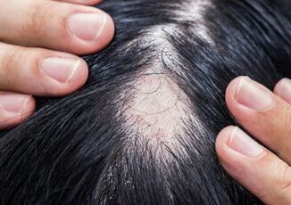 Alopecia areata ok Aifa a rimborsabilita nuovo trattamento